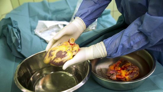Rekordot döntött tavaly a szívtranszplantációk száma Magyarországon