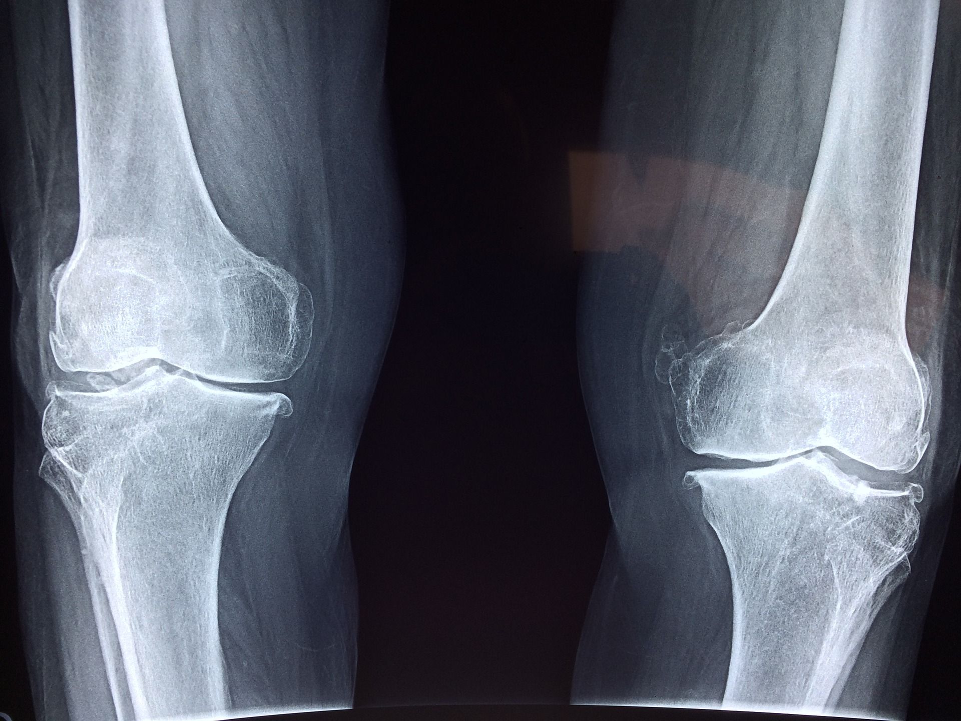 csípőízületi arthrosis 1 fokozatú kezelés térd bursitis sérülés után