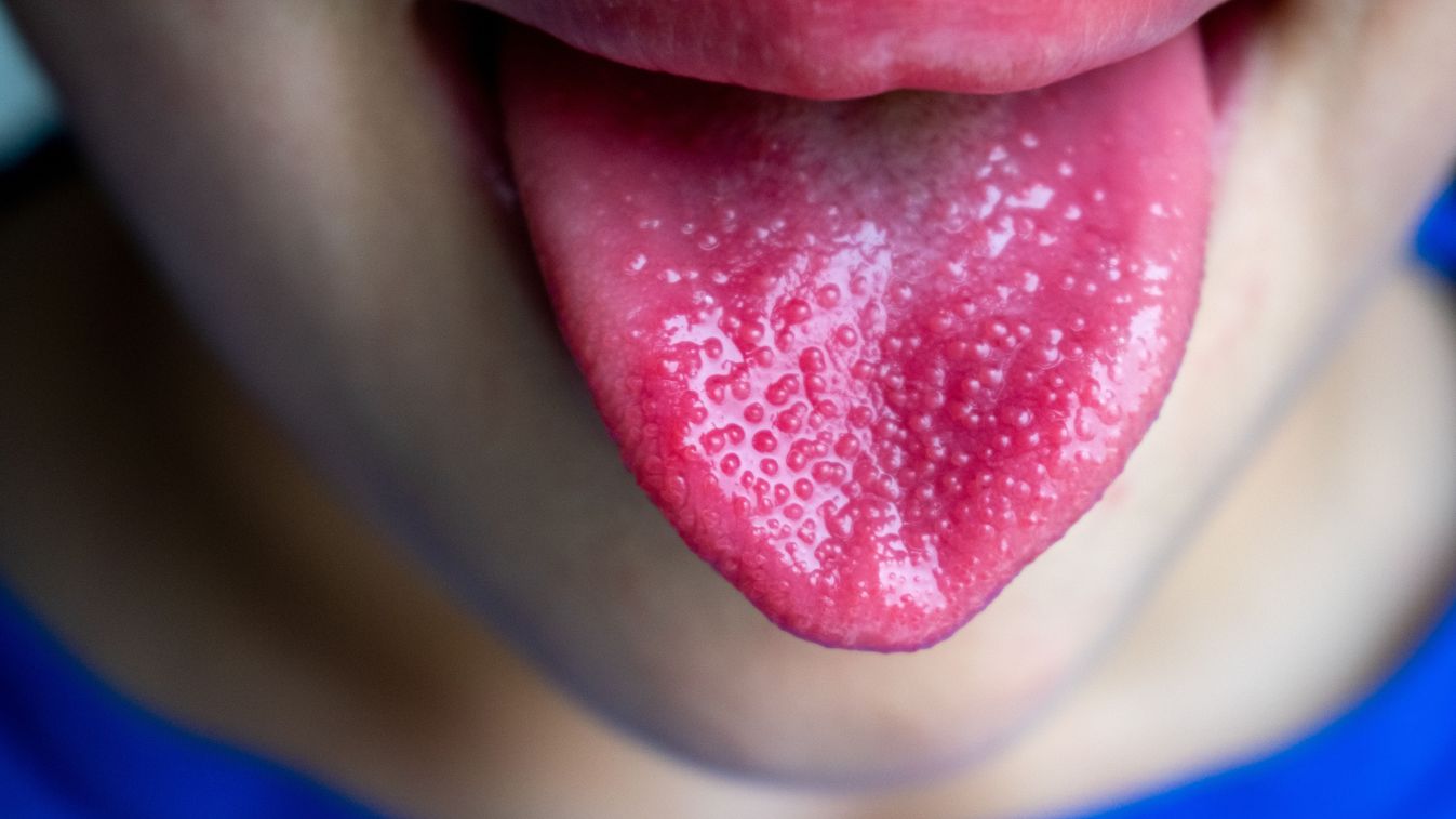 Strawberry,Tongue,,Sign,Of,Streptococcus,Infection,málnanyelv,skarlát