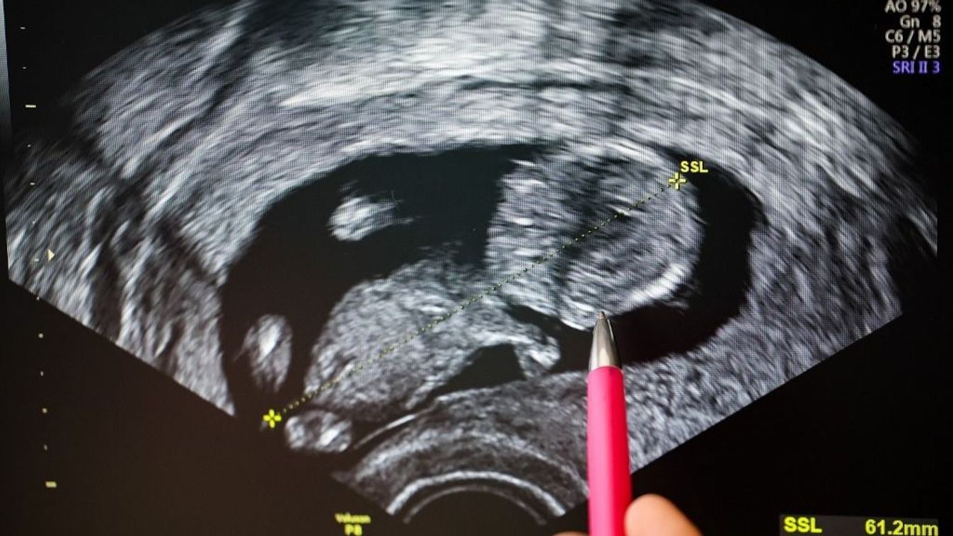 Pregnancy - Ultrasound image