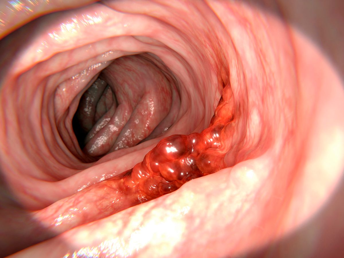 Computer illustration of a malignant (cancerous) tumour (red) in the colon. Risk factors for colorectal cancer are smoking, obesity and lack of physical activity. (Photo by JGT / Science Photo Library via AFP)