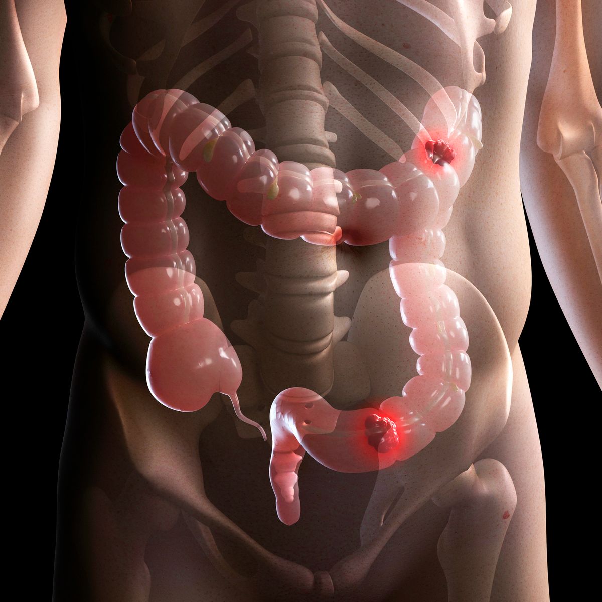 Bowel cancer, computer artwork.