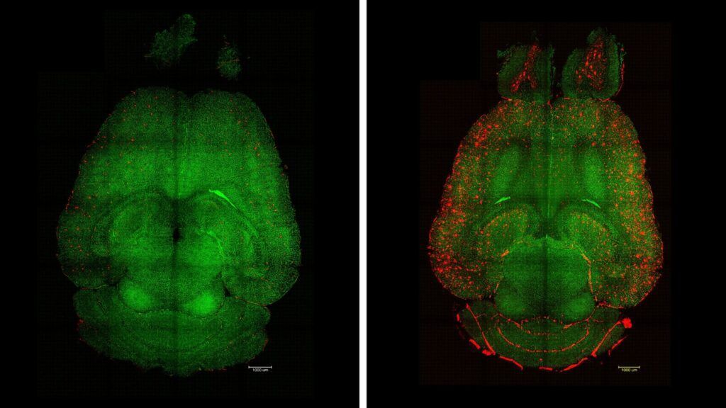 gyógyíthatatlan Alzheimer-kóros