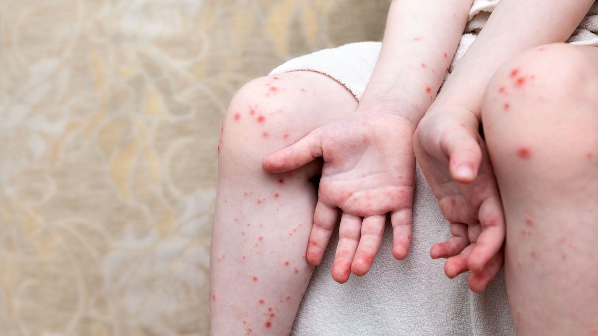 Különösen a gyermekekre veszélyes a szomszédos országban terjedő vírus