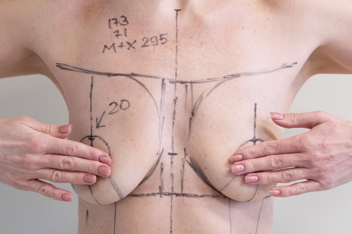 woman patient with medical surgical marks drawn on chest for plastic surgery preparation, medical mammoplasty, mastopexy breast enlargement, on white background
1206 Lugas