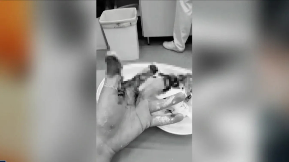 A gyerek keze teljesen szétroncsolódott a tiltott tűzijáték miatt