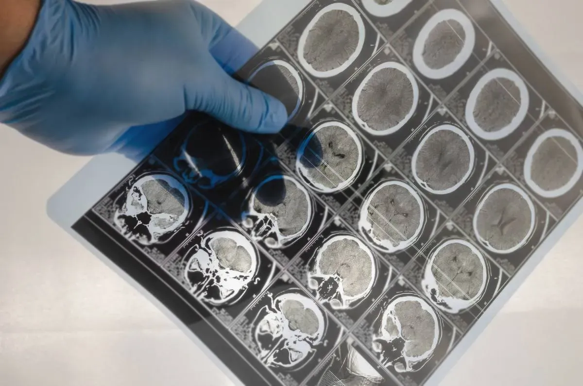 vércsoport, agyvérzés, stroke